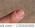Acute Paronychia Infection on Fingernail Close-Up 135016266