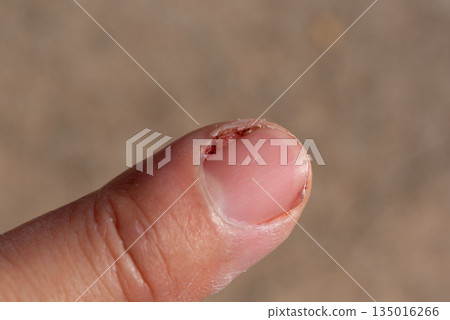 Acute Paronychia Infection on Fingernail Close-Up 135016266