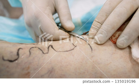 The process of surgery to eliminate varicose veins on the leg. The male hands of a doctor do an operation on the veins, on the patient's leg. Preparation of the patient for radiofrequency ablation of The process of surgery to eliminate varicose veins on the leg. The male hands of a doctor do an operation on the veins, on the patient's leg. Preparation of the patient for radiofrequency ablation of 135019196