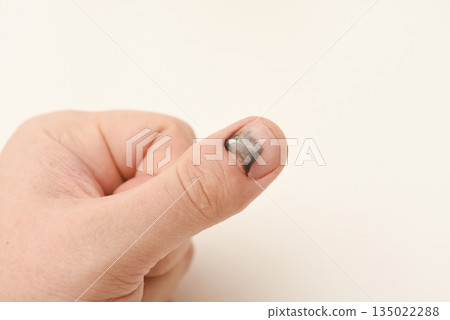 A damaged finger on the hand. A damaged nail and blood under the nail. Regeneration of the fingernail. 135022288