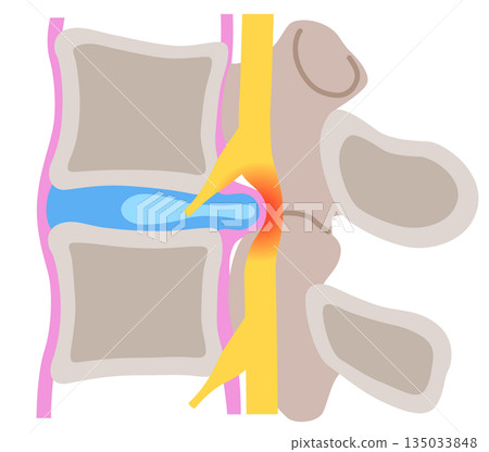腰椎間盤突出、椎間盤結構、下背痛 腰椎間盤突出、椎間盤結構、下背痛 135033848