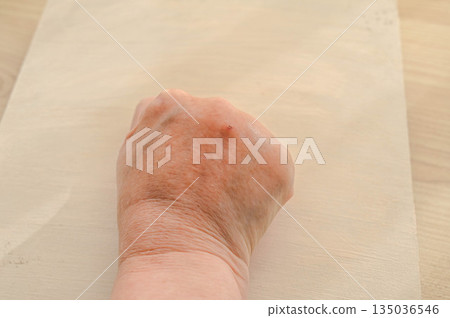 A swollen fist bitten by a pet cat A swollen fist bitten by a pet cat 135036546