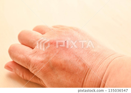 被寵物貓咬傷後拳頭腫脹 135036547