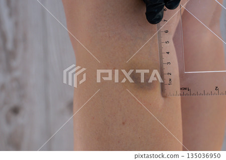 Doctor in medical gloves examining length and width of bruises on body at home scene. Close-up of woman with bruised leg. Bruising leg area, injury accident. Concept of home abuse. Consequences 135036950