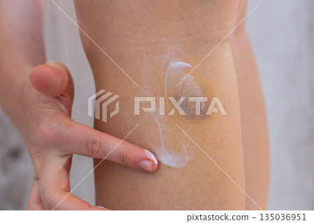 Unrecognized person rubbing recovery healing cream bruises on body at home scene. Close-up of woman with bruised leg. Bruising leg area, injury accident. Concept of home abuse. Consequences 135036951