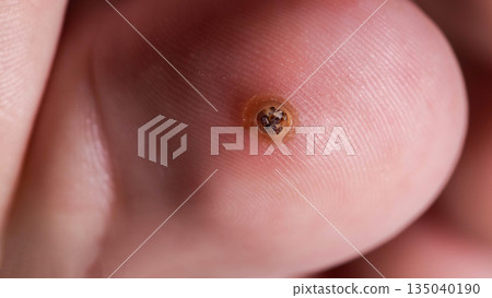 Detailed Macro Shot Of A Verruca Plantaris. This Close View Examines The Toe Wart Caused By A Virus. Detailed Macro Shot Of A Verruca Plantaris. This Close View Examines The Toe Wart Caused By A Virus. 135040190