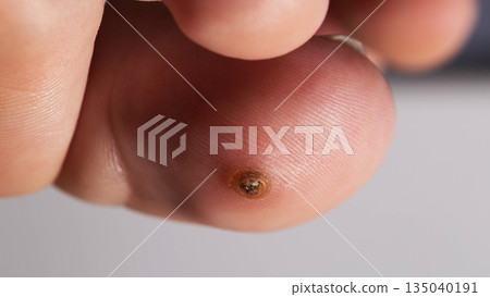 Close View Of A Circular Verruca On A Toe. The Macro Lens Captures The Wart's Details. 135040191