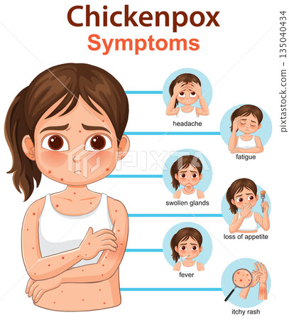 Chickenpox Symptoms Illustrated in Young Girl Vector Diagram Chickenpox Symptoms Illustrated in Young Girl Vector Diagram 135040434