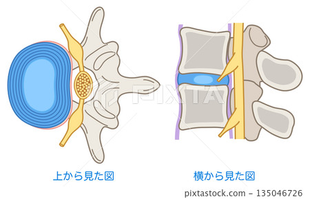 Structure of the lumbar disc: Lumbar disc herniation Structure of the lumbar disc: Lumbar disc herniation 135046726