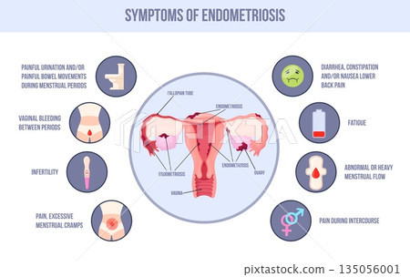 Endometriosis symptom. Uterus endometrium period pcos symptoms medical infographic gynecology, female reproductive system womb health polycystic pain, neat vector illustration 135056001