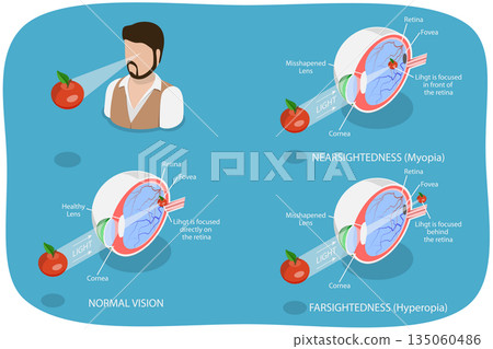 3D Isometric Flat  Illustration of Vision Disorder, Far-Sightedness And Near-Sightedness Anatomical Diagram 135060486