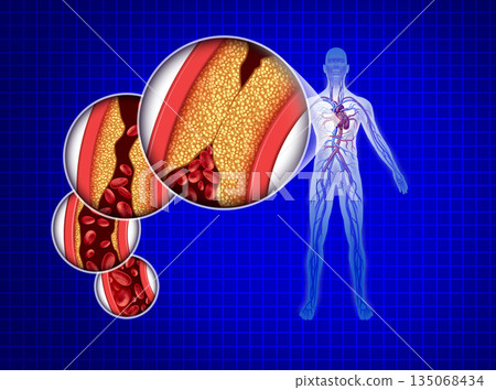 Heart Attack and blocked Human Cardiovascular Circulation 135068434