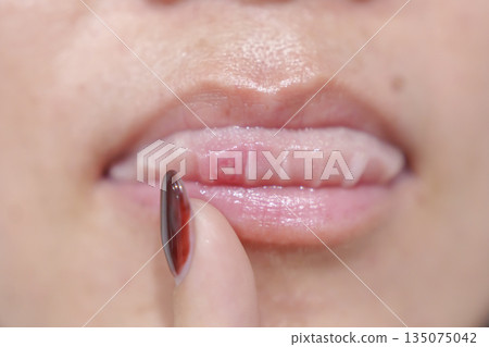 Mouth Ulcer Sore or Aphthous Stomatitis. Oral Health and Medical concepts Mouth Ulcer Sore or Aphthous Stomatitis. Oral Health and Medical concepts 135075042