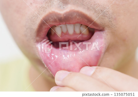 Mouth Ulcer Sore or Aphthous Stomatitis. Oral Health and Medical concepts Mouth Ulcer Sore or Aphthous Stomatitis. Oral Health and Medical concepts 135075051