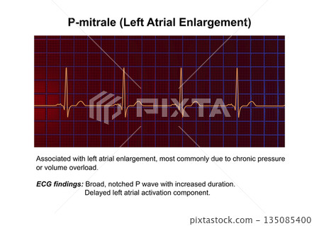 P-mitrale, 3D illustration P-mitrale, 3D illustration 135085400