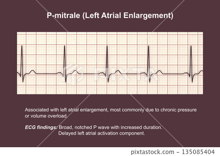 P-mitrale, 3D illustration 135085404
