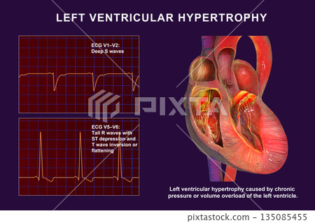 Left ventricular hypertrophy, 3D illustration showing thickened left ventricular myocardium with ECG examples in leads V1-V2 and V5-V6 demonstrating voltage changes 135085455