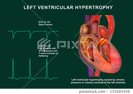 Left ventricular hypertrophy, 3D illustration showing thickened left ventricular myocardium with ECG examples in leads V1-V2 and V5-V6 demonstrating voltage changes Left ventricular hypertrophy, 3D illustration showing thickened left ventricular myocardium with ECG examples in leads V1-V2 and V5-V6 demonstrating voltage changes 135085456