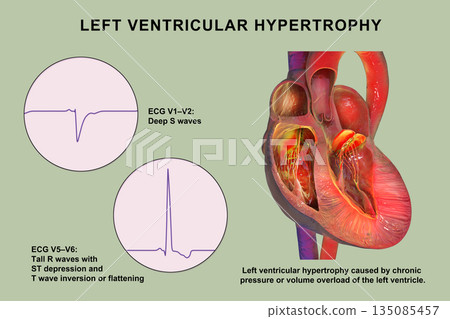Left ventricular hypertrophy, 3D illustration showing thickened left ventricular myocardium with ECG examples in leads V1-V2 and V5-V6 demonstrating voltage changes Left ventricular hypertrophy, 3D illustration showing thickened left ventricular myocardium with ECG examples in leads V1-V2 and V5-V6 demonstrating voltage changes 135085457