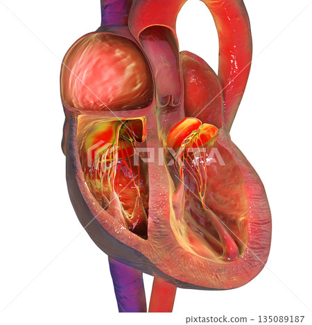 Right atrial enlargement, 3D illustration 135089187