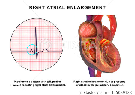 Right atrial enlargement with P-pulmonale, 3D illustration Right atrial enlargement with P-pulmonale, 3D illustration 135089188