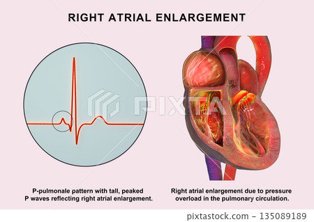 Right atrial enlargement with P-pulmonale, 3D illustration Right atrial enlargement with P-pulmonale, 3D illustration 135089189