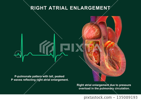 Right atrial enlargement with P-pulmonale, 3D illustration Right atrial enlargement with P-pulmonale, 3D illustration 135089193