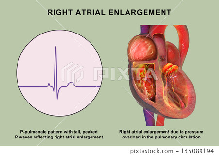 Right atrial enlargement with P-pulmonale, 3D illustration Right atrial enlargement with P-pulmonale, 3D illustration 135089194