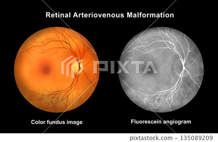 Retinal arteriovenous malformation, illustration Retinal arteriovenous malformation, illustration 135089209
