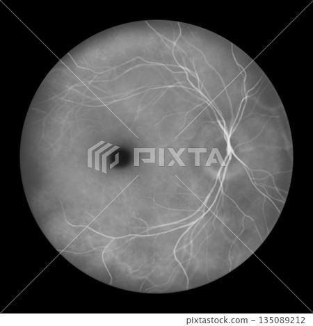 Best disease stage 2, illustration Best disease stage 2, illustration 135089212