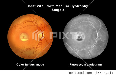 Best disease stage 3, illustration Best disease stage 3, illustration 135089214