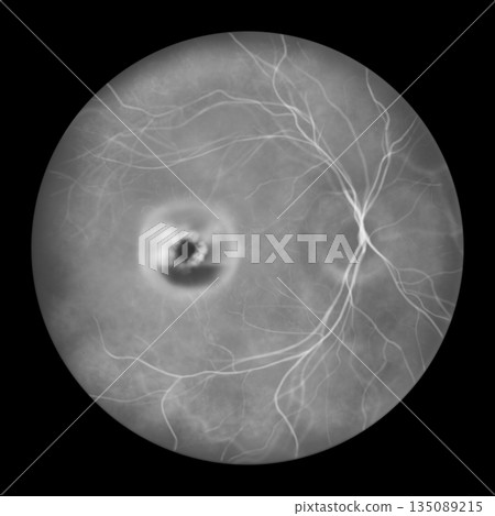 Best disease stage 3, illustration 135089215