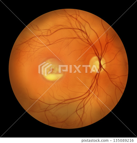 Best disease stage 3, illustration Best disease stage 3, illustration 135089216