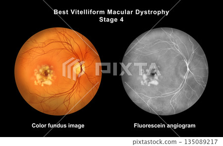 Best disease stage 4, illustration Best disease stage 4, illustration 135089217