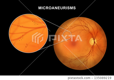 Retina with microaneurysms, illustration Retina with microaneurysms, illustration 135089219