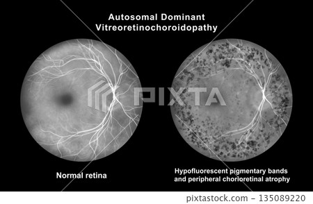 Retina with microaneurysms, illustration 135089220