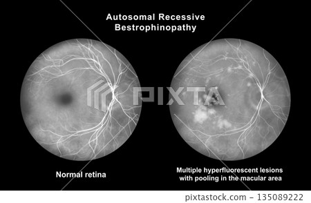 Retina with microaneurysms, illustration 135089222