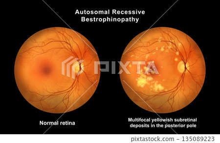 Retina with microaneurysms, illustration Retina with microaneurysms, illustration 135089223