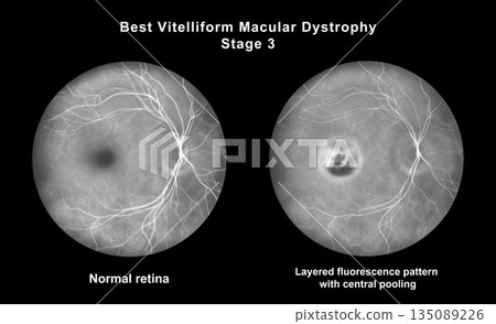 Retina with microaneurysms, illustration Retina with microaneurysms, illustration 135089226