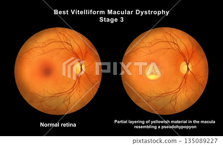 Retina with microaneurysms, illustration Retina with microaneurysms, illustration 135089227