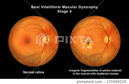 Retina with microaneurysms, illustration Retina with microaneurysms, illustration 135089229