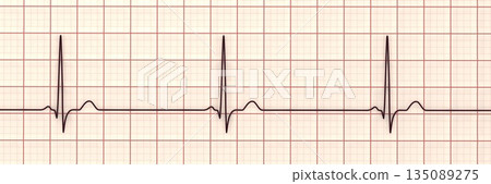 Sinus bradycardia, 3D illustration Sinus bradycardia, 3D illustration 135089275
