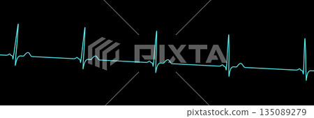 Sinus bradycardia, 3D illustration Sinus bradycardia, 3D illustration 135089279