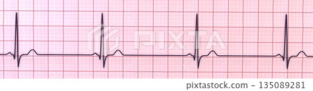 Sinus bradycardia, 3D illustration Sinus bradycardia, 3D illustration 135089281