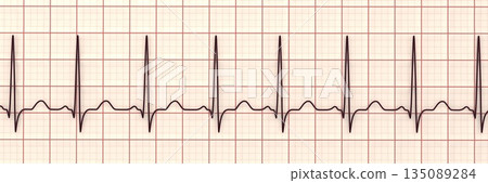 Sinus tachycardia, 3D illustration 135089284