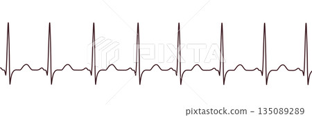 Sinus tachycardia, 3D illustration Sinus tachycardia, 3D illustration 135089289