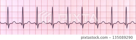 Sinus tachycardia, 3D illustration 135089290