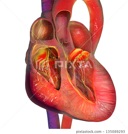 Biventricular hypertrophy, 3D illustration 135089293