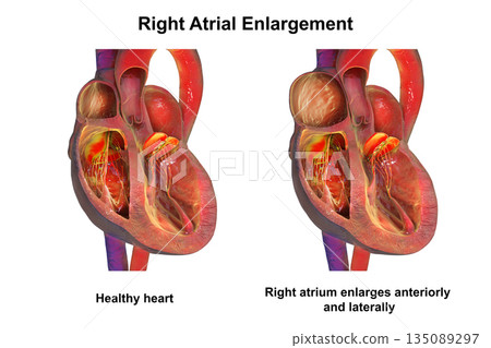 Healthy heart vs right atrial enlargement, 3D illustration 135089297
