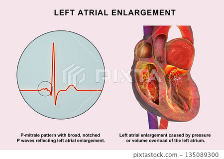 Left atrial dilation with P-mitrale, 3D illustration Left atrial dilation with P-mitrale, 3D illustration 135089300